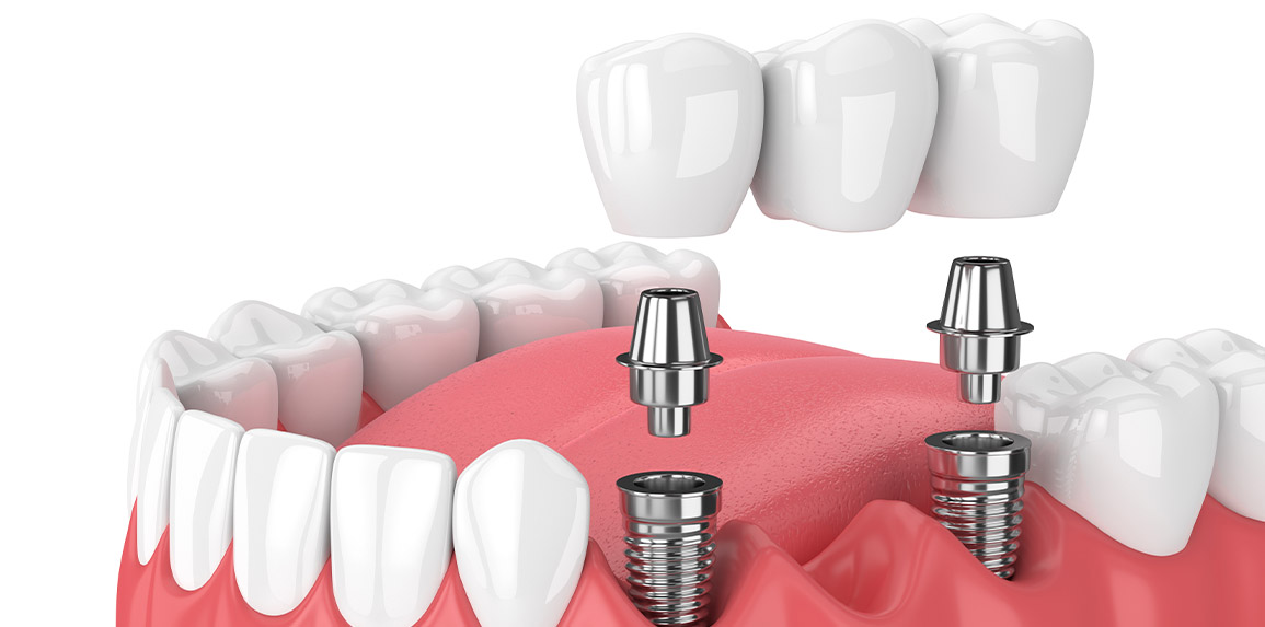 blog inner thumb : The Edge dental