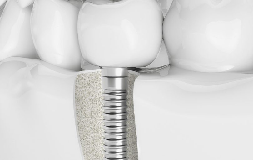 blog - The Edge dental