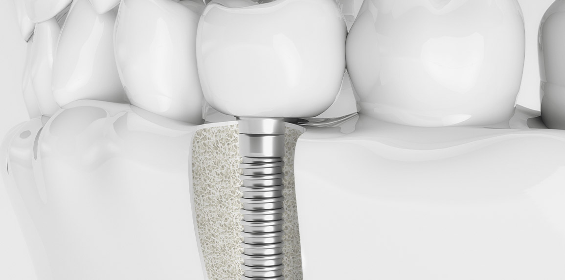 blog inner thumb : The Edge dental