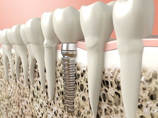 Dental Implant Advantage 2