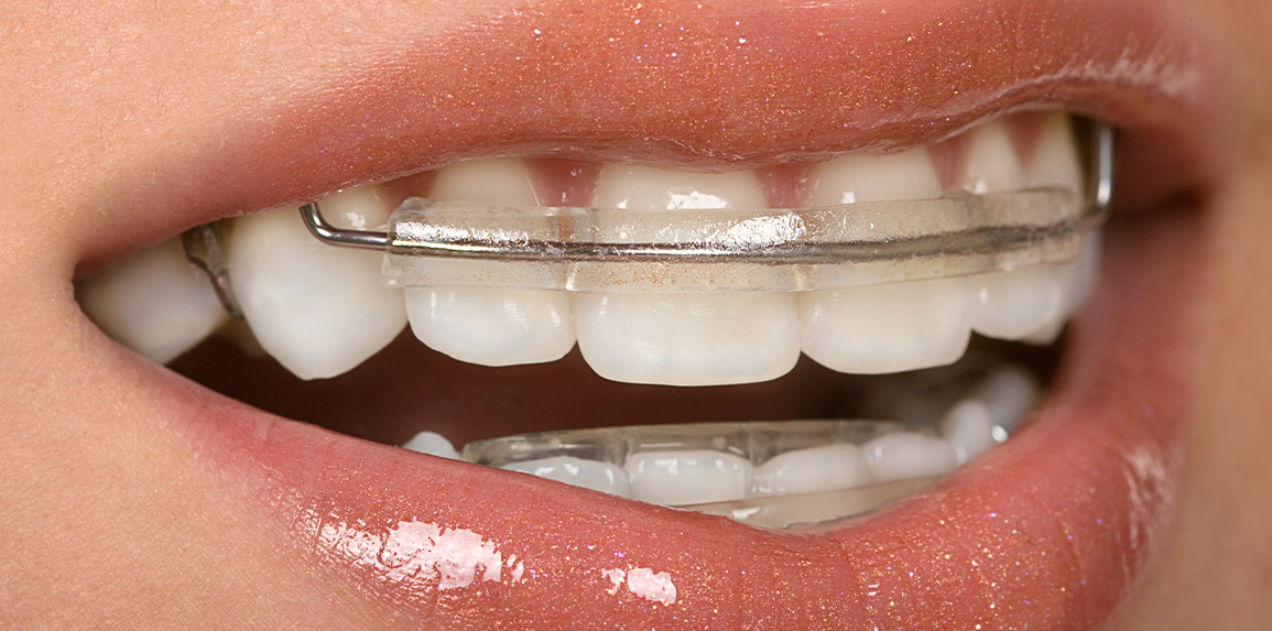 blog - The Edge dental