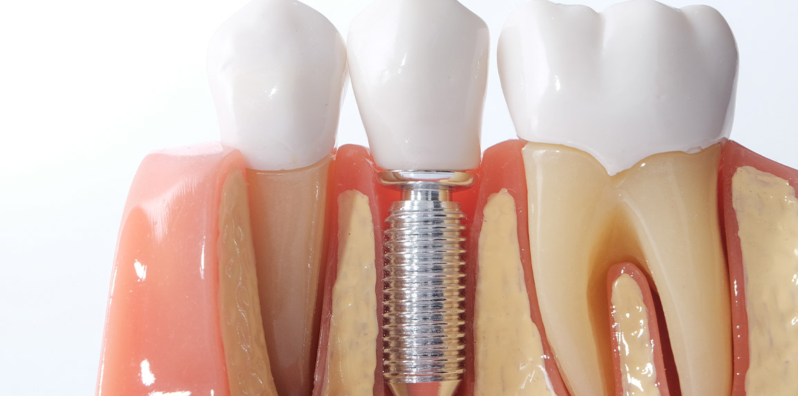 blog inner thumb : The Edge dental