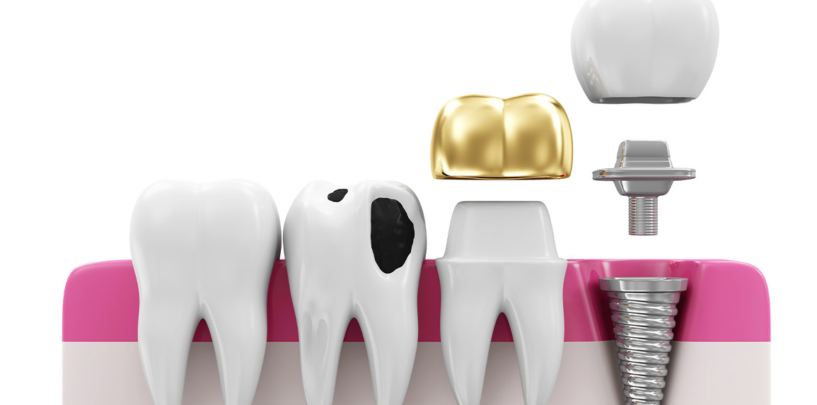 blog - The Edge dental