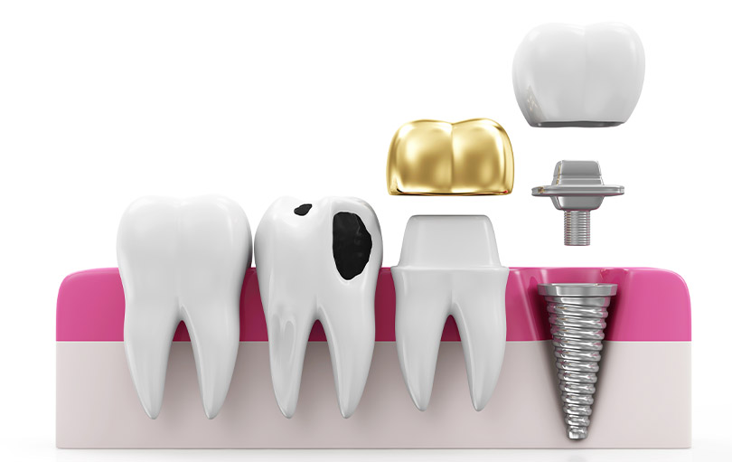 blog - The Edge dental