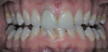 Crowns Case 1 After