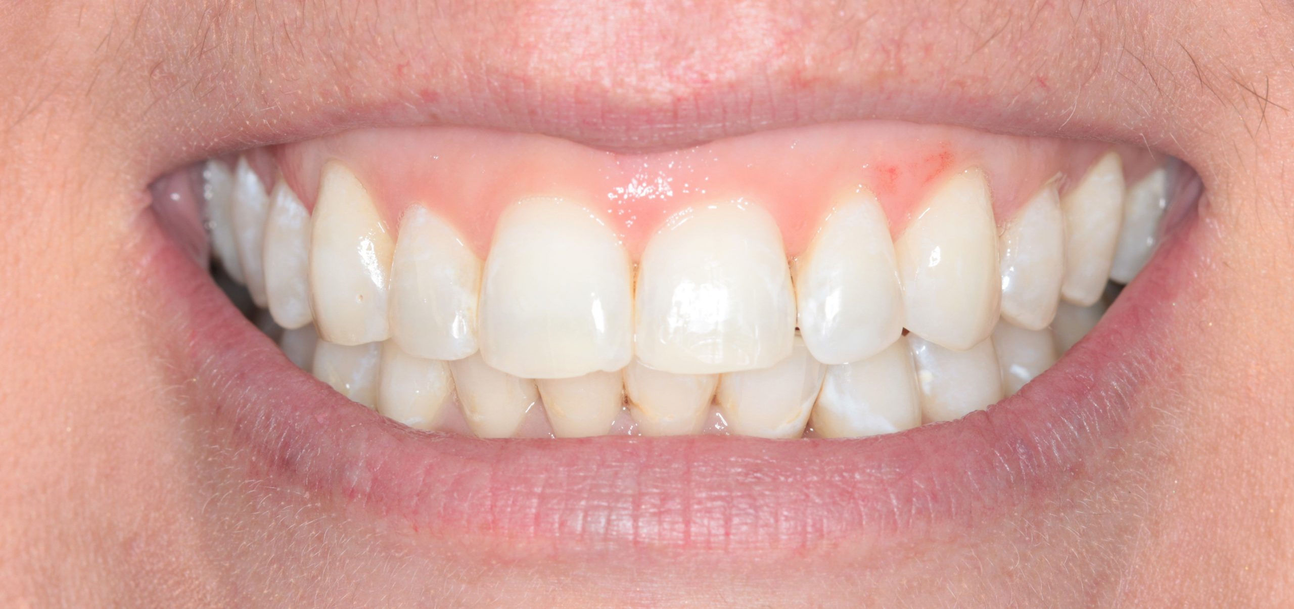 Whitening Case 2 After Scaled