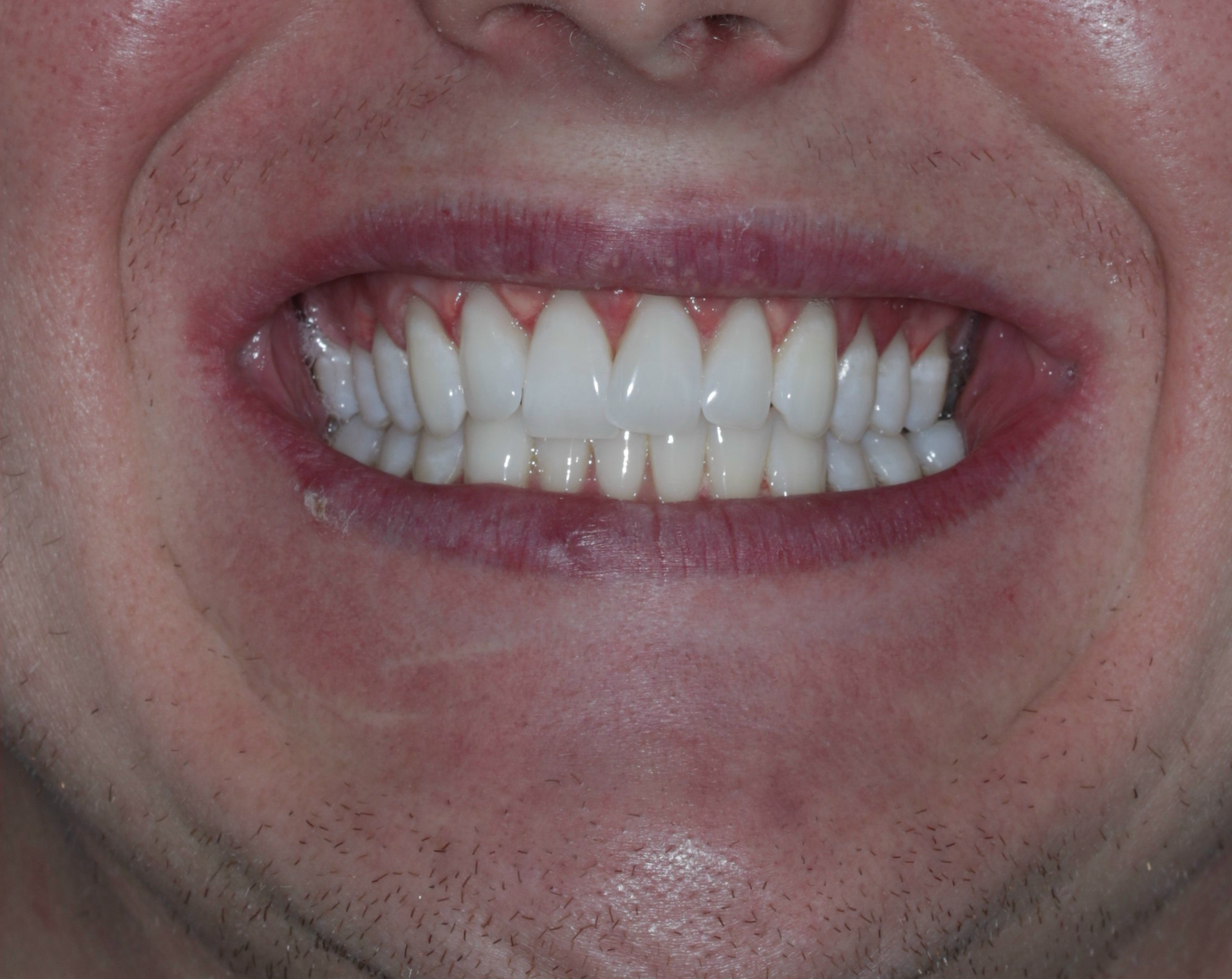 Whitening Case 3 After