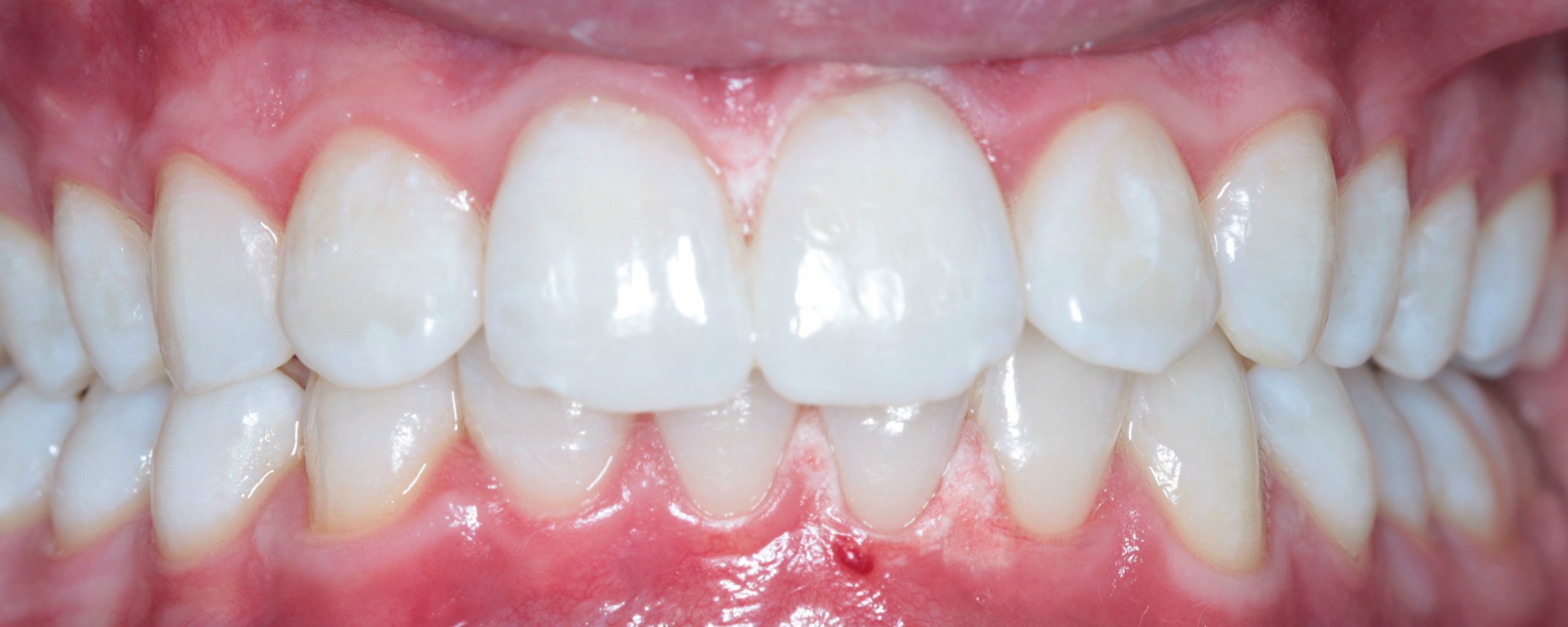 Whitening Case 4 After Scaled