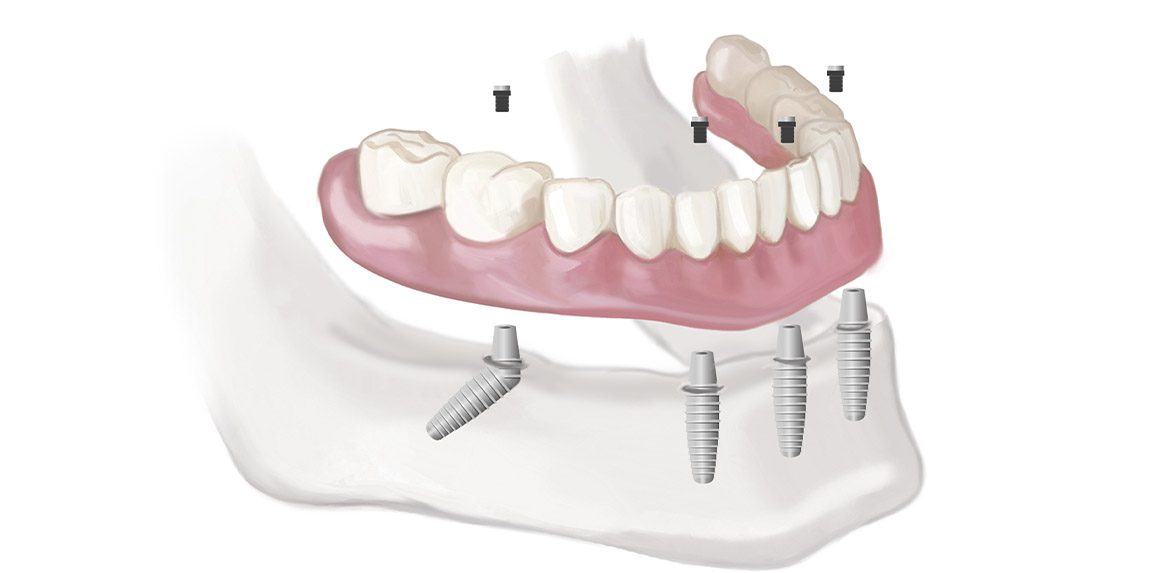 blog inner thumb : The Edge dental