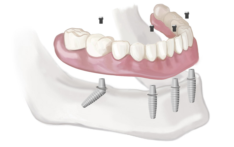 blog - The Edge dental