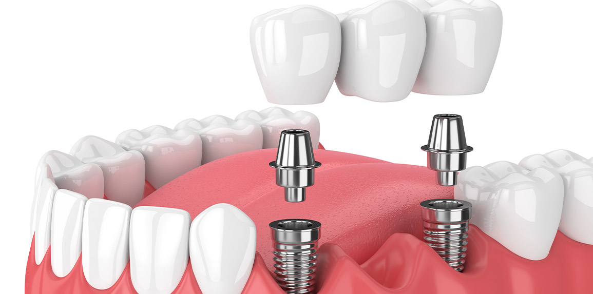 blog inner thumb : The Edge dental