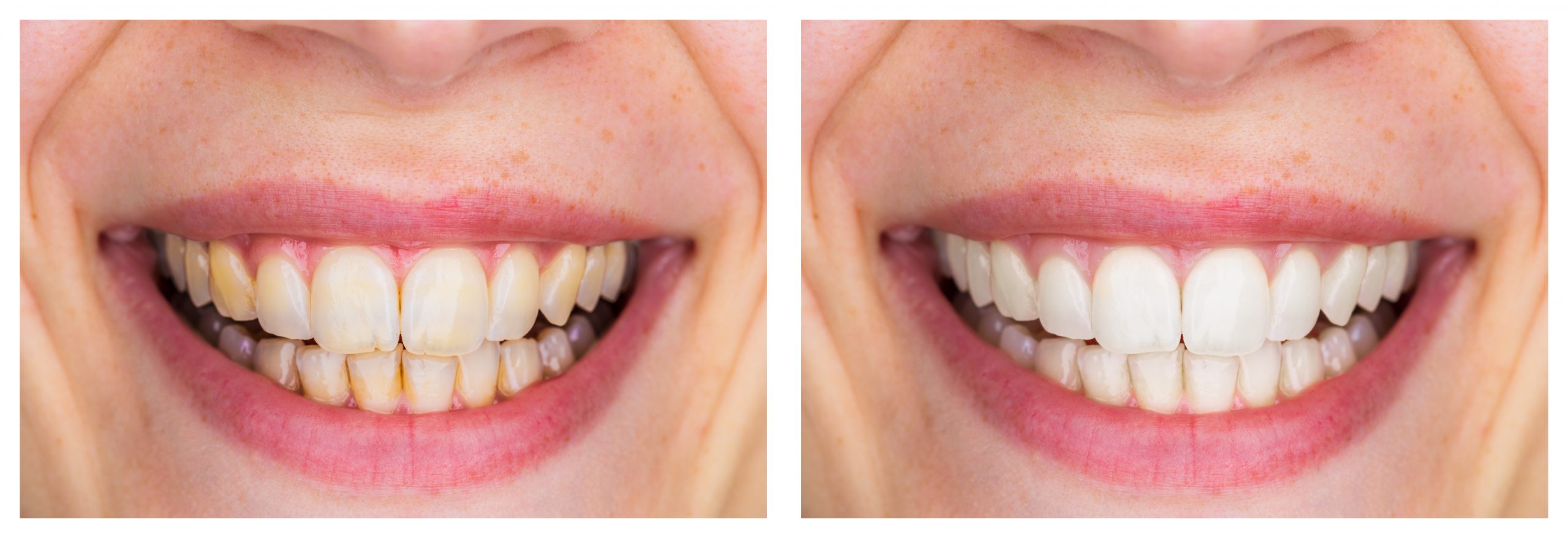 Teeth Whitening Before   After Aug Blog Scaled