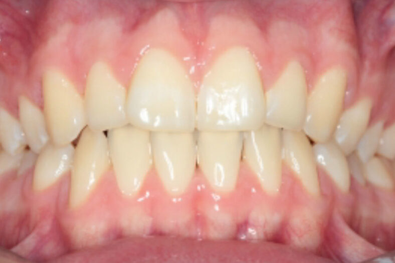 Before - The Edge Dental