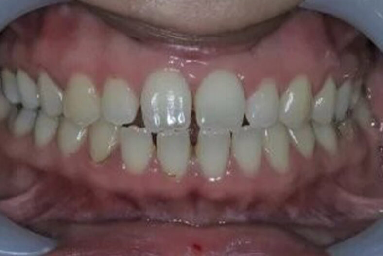 Before - The Edge Dental