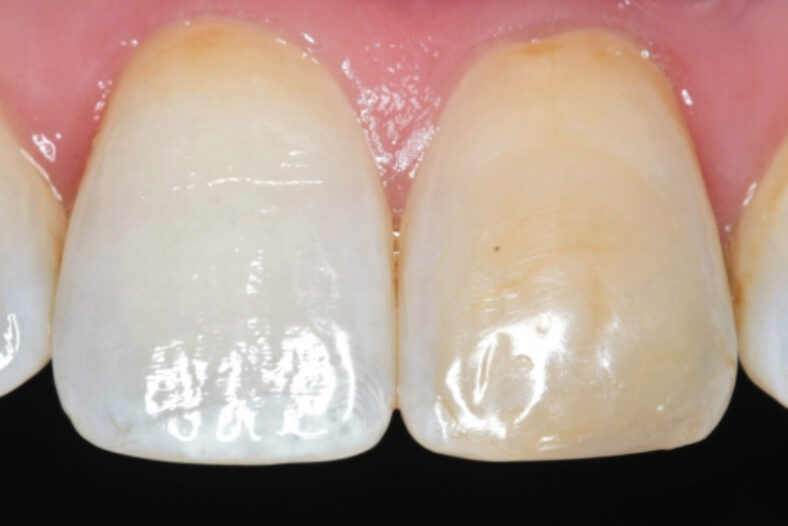 Before - The Edge Dental