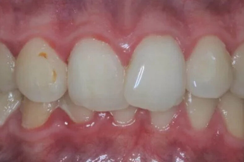 Before - The Edge dental