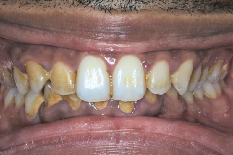 Before - The Edge Dental