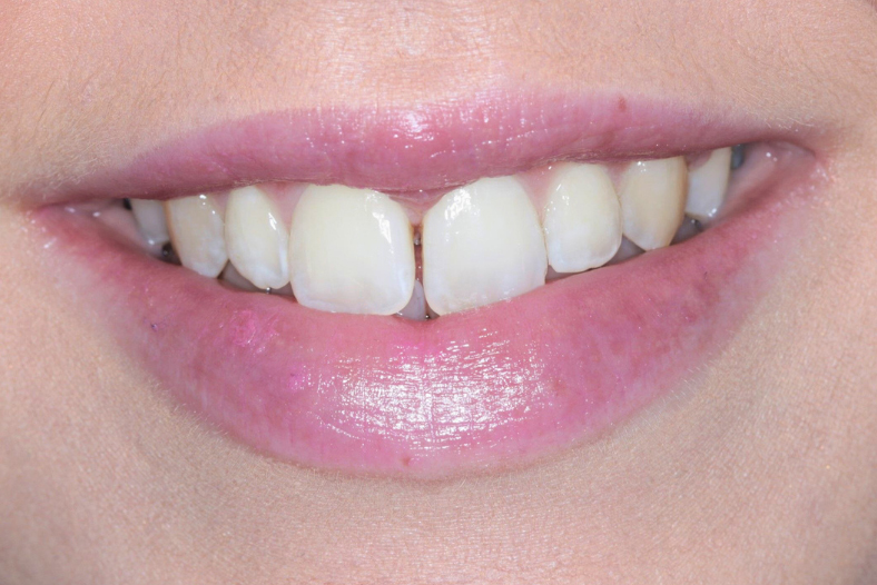 Before - The Edge Dental