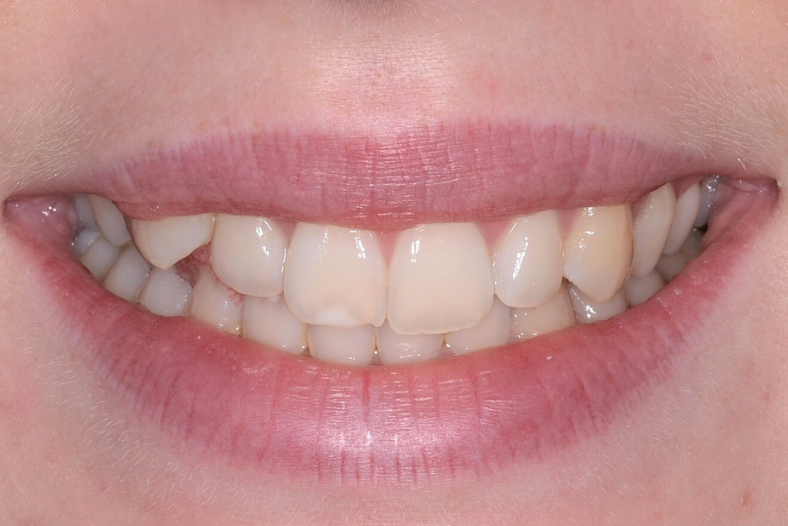 Before - The Edge Dental