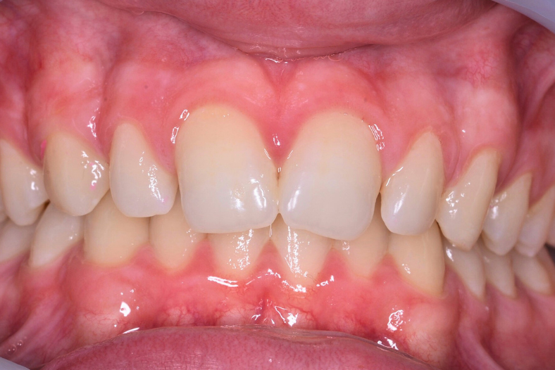 Before - The Edge Dental