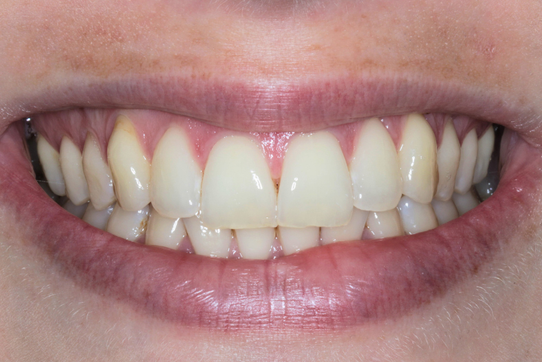 Before - The Edge Dental