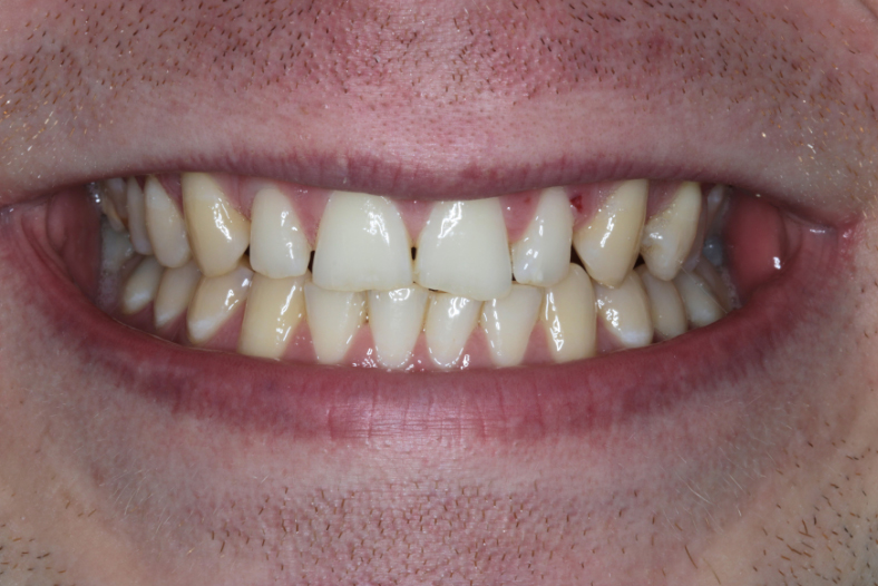 Before - The Edge Dental