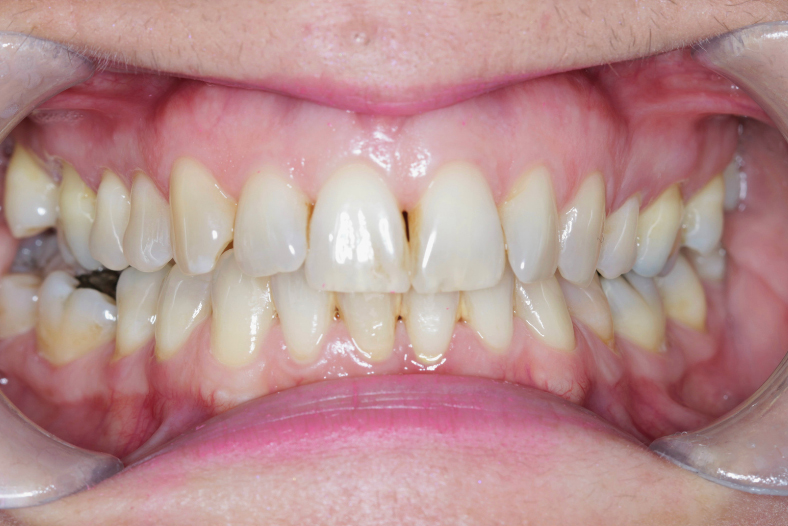 Before - The Edge Dental