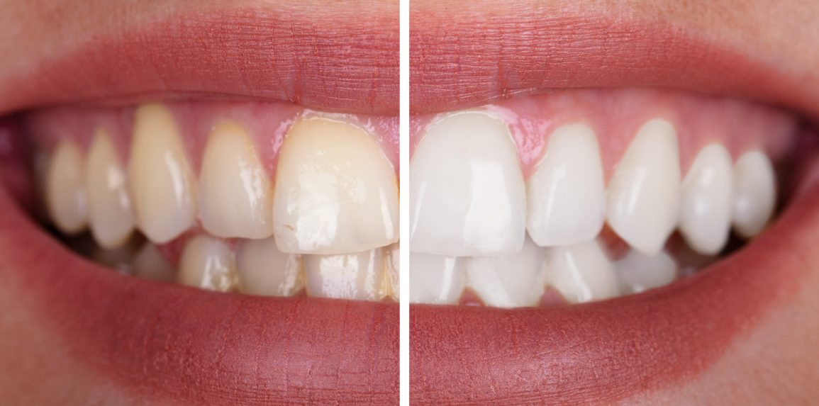 blog - The Edge dental